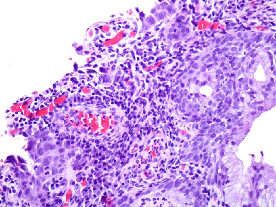 Lesión intraepitelial escamosa de alto grado (HSIL) (9321367240)