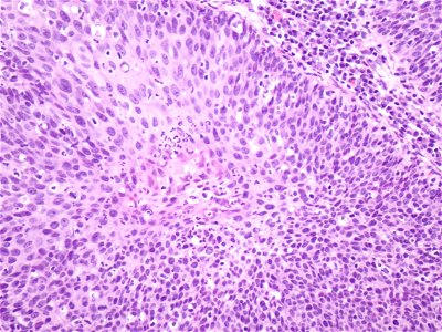 Lesión intraepitelial escamosa de alto grado (HSIL, CIN3) (9388755847)