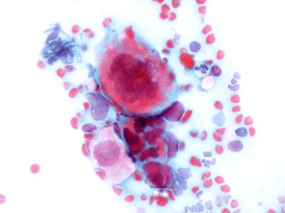 Lesión intraepitelial escamosas de bajo grado (LSIL) (9295343700)