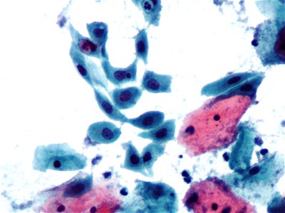 Metaplasia escamosa (cuello de útero) (9399641299)