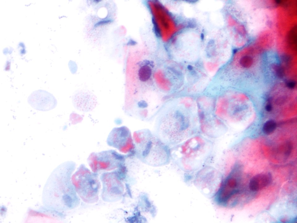 Trichomonas (9389745101)