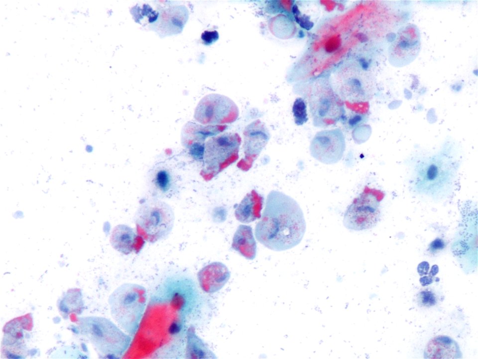 Trichomonas (9389744677)