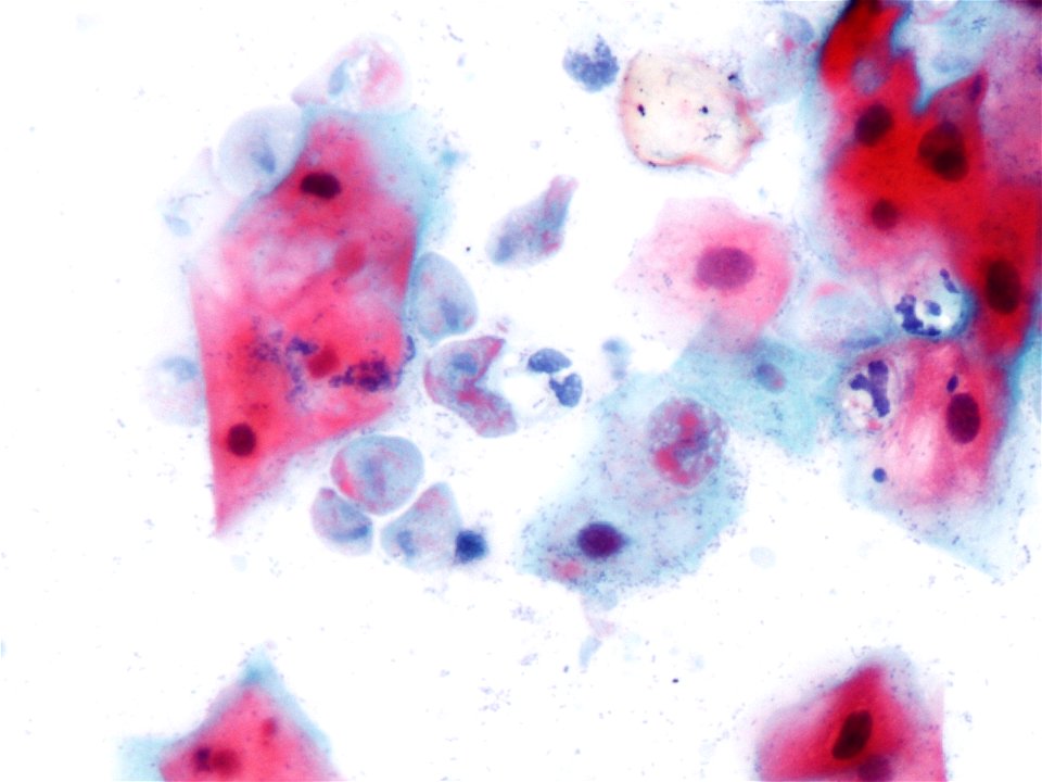 Trichomonas (9389744527)