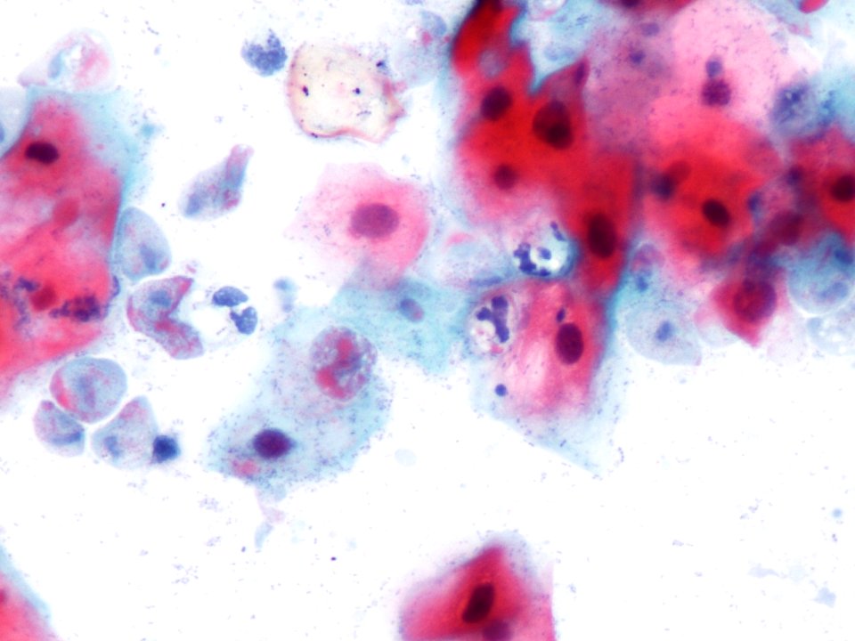 Trichomonas (9392520130)