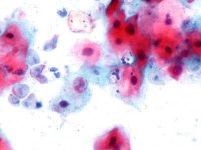 Trichomonas (9392520130)