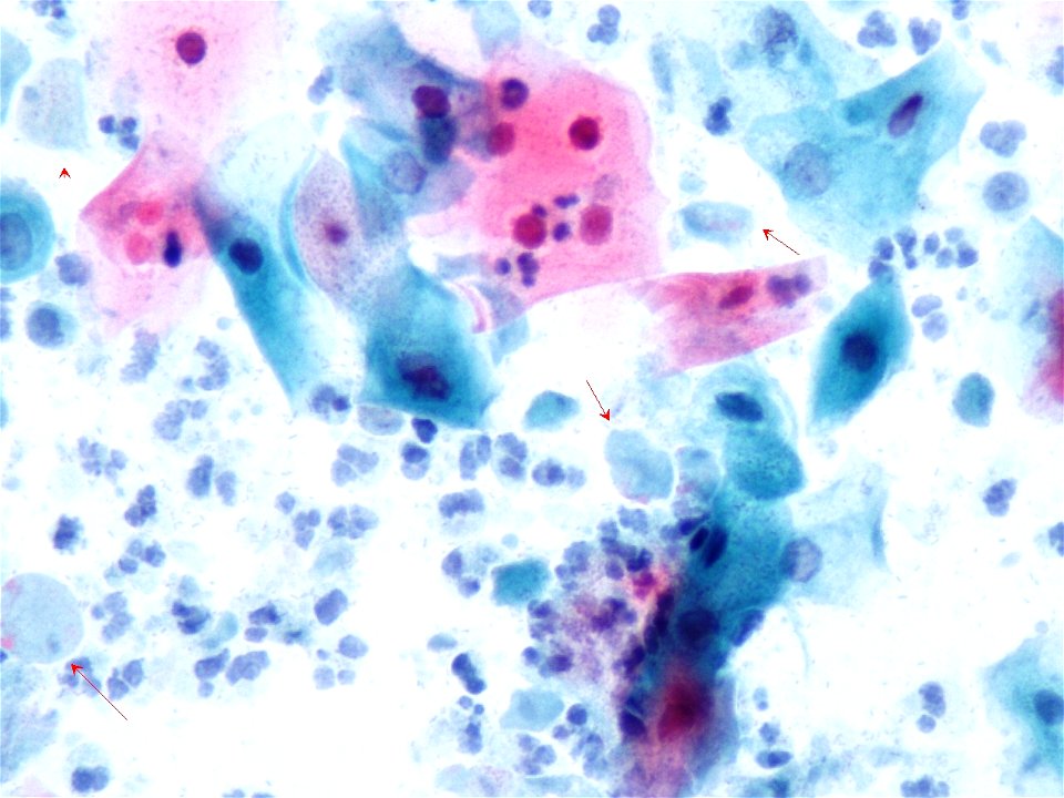 Trichomonas (9361156742)