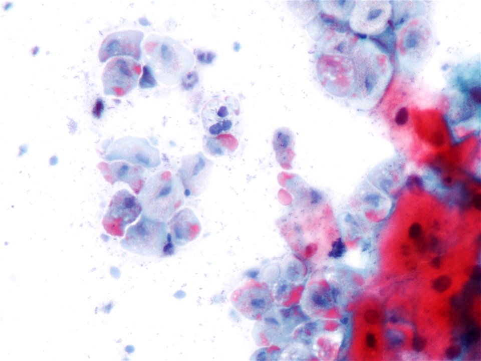 Trichomonas (9389745029)