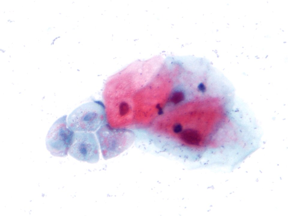 Trichomonas (9389744945)