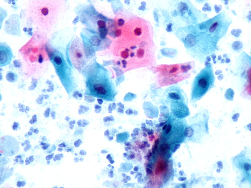 Trichomonas (9358377959)