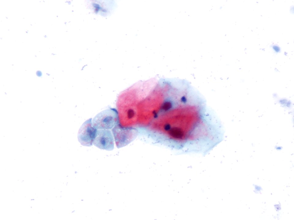 Trichomonas (9389744735)