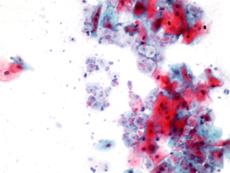 Trichomonas (9392520488)
