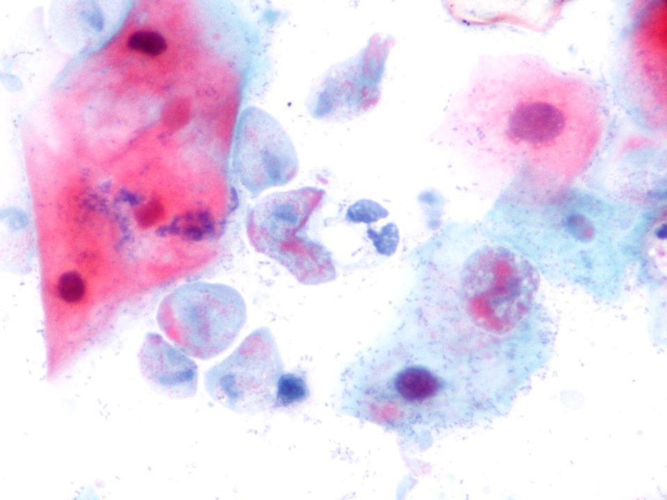 Trichomonas (9389744631)