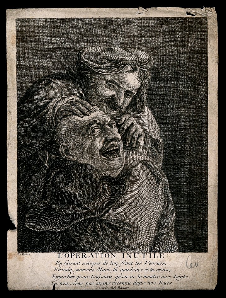 A malicious itinerant surgeon extracting stones from a grima Wellcome V0016248EL