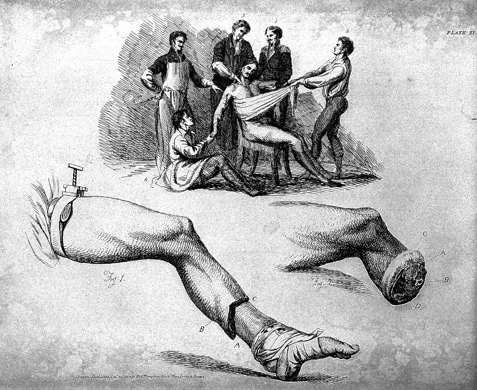 Amputation of the shoulder-joint and the leg Wellcome L0006117