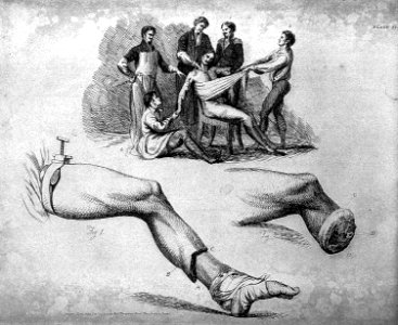 Amputation of the shoulder-joint and the leg Wellcome L0006117
