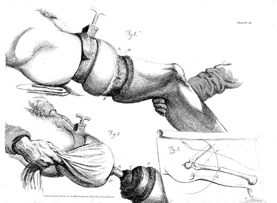 Amputation of the thigh, 19th century Wellcome L0001337