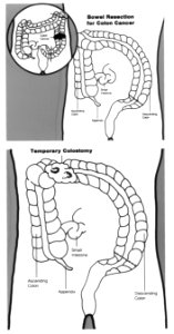 Bowel resection and temporary colostomy illustration