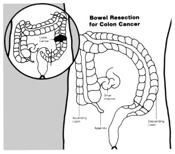Bowel resection illustration