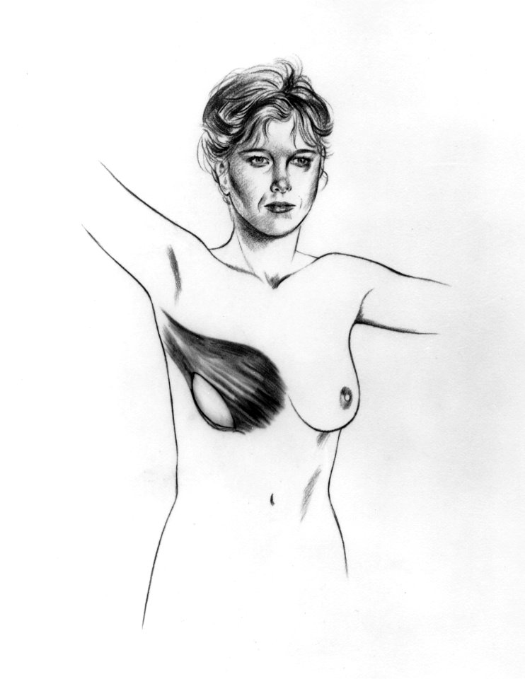 Breast reconstuction latissimus dorsi illustration (1)