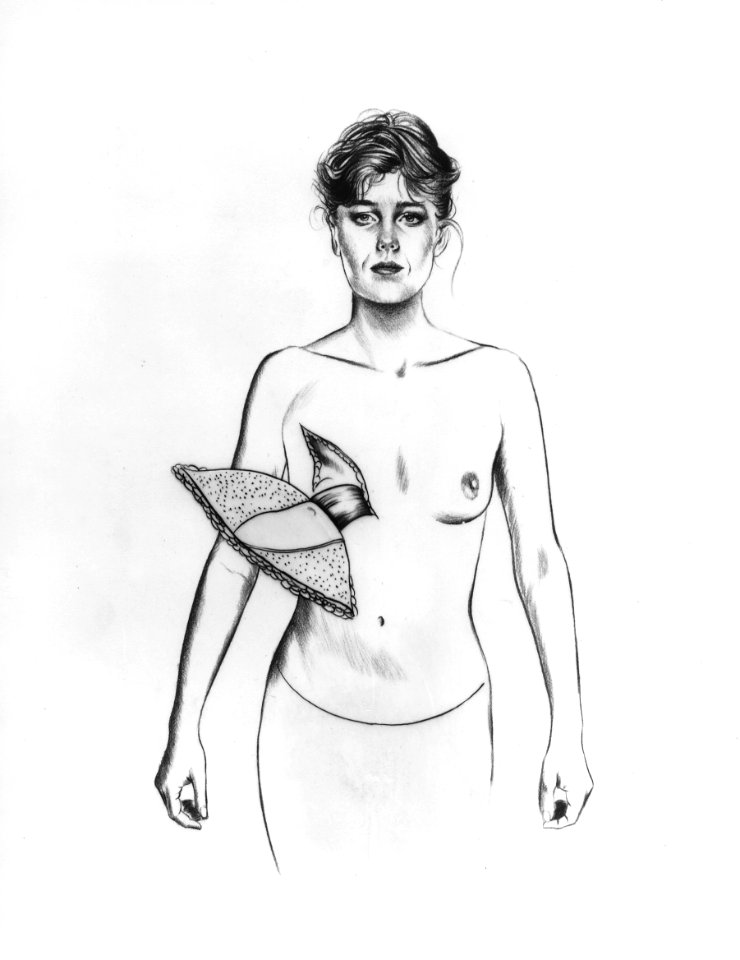 Breast reconstruction rectus abdominus illustration (2)