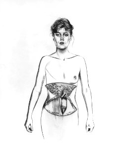 Breast reconstruction rectus abdominus illustration (1)