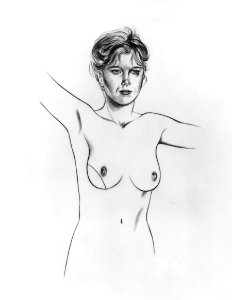 Breast reconstuction latissimus dorsi illustration (2)