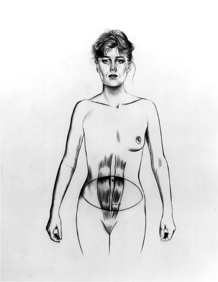 Breast reconstruction rectus abdominus illustration
