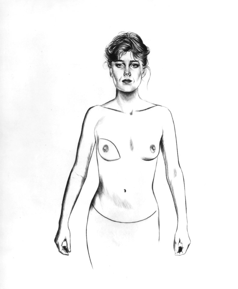 Breast reconstruction rectus abdominus illustration (3)