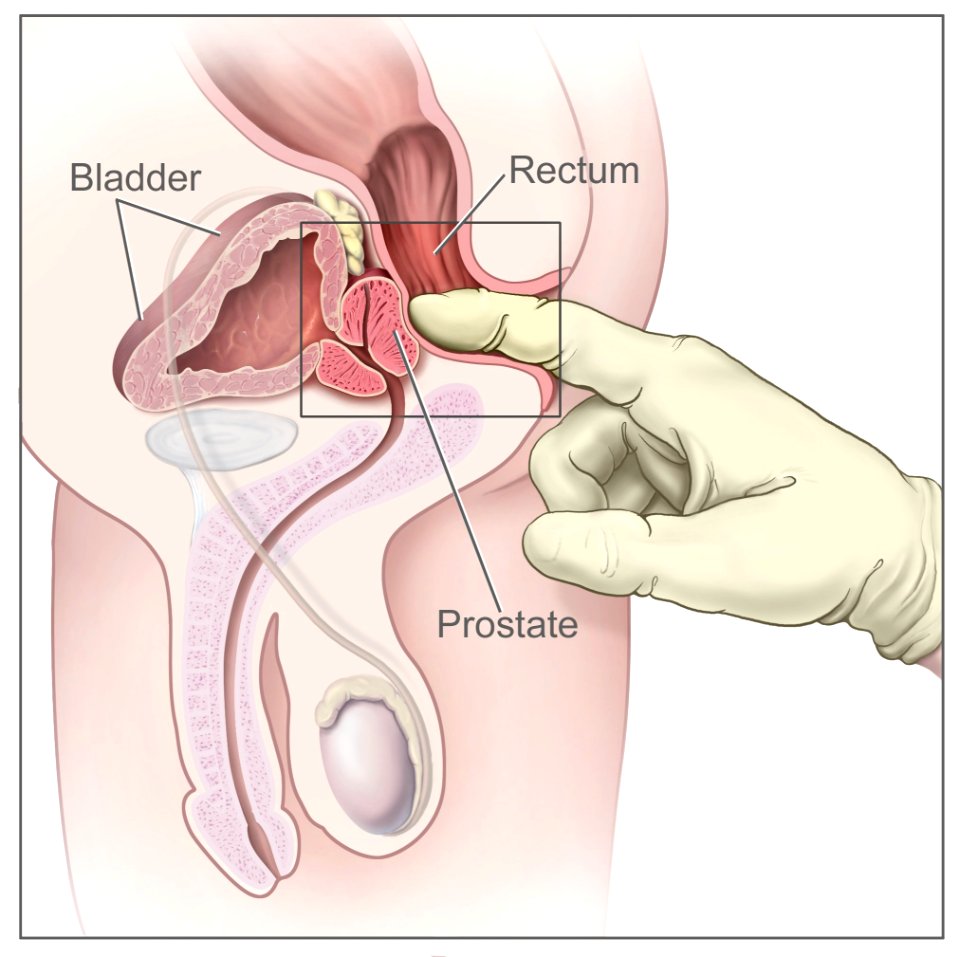 Digital rectal exam