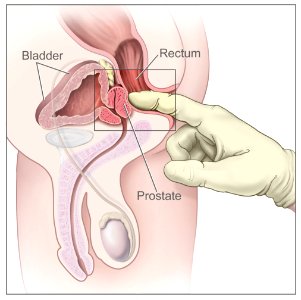 Digital rectal exam