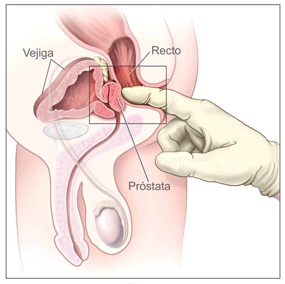 Digital rectal exam - spanish