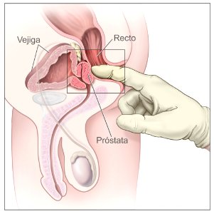 Digital rectal exam - spanish