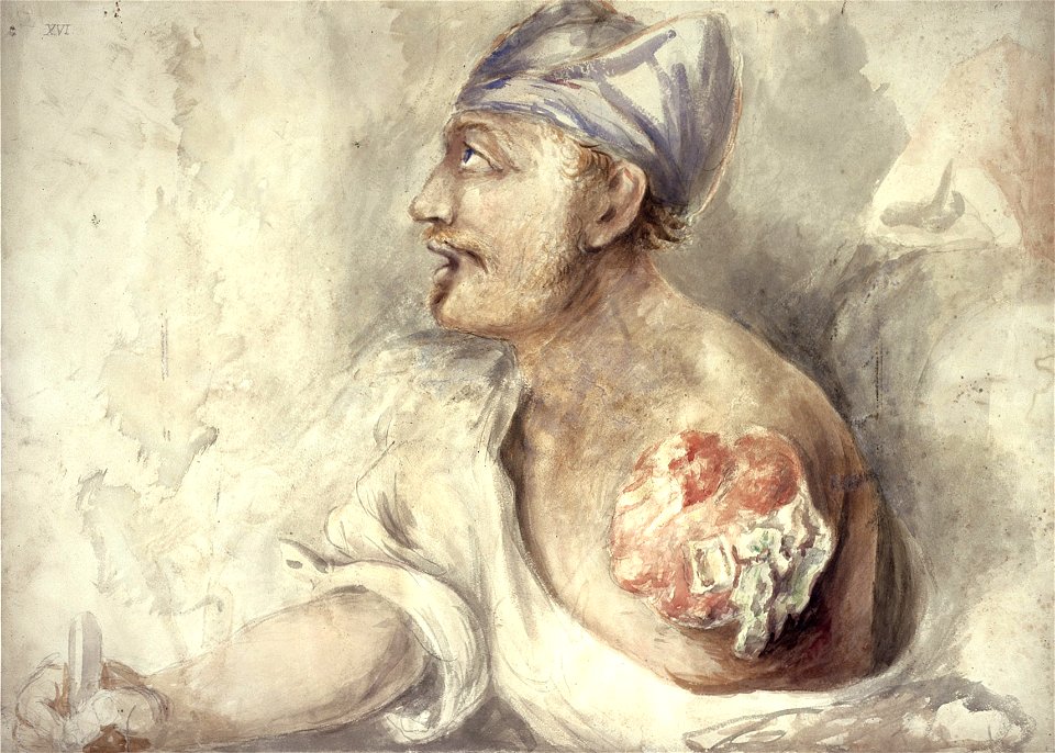 Arm shattered, Voultz, by Charles Bell Wellcome L0028901