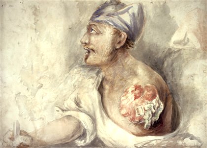 Arm shattered, Voultz, by Charles Bell Wellcome L0028901