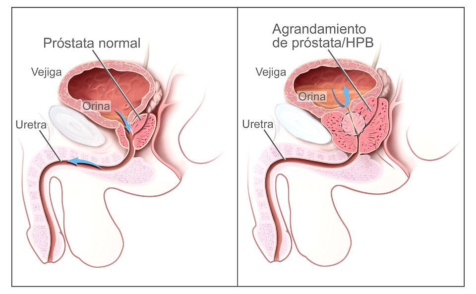 Benign prostatic hyperplasia - spanish