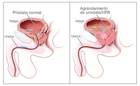 Benign prostatic hyperplasia - spanish