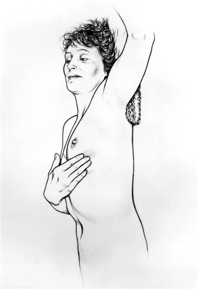 Bse after mastectomy (series of 6) illustration (5)