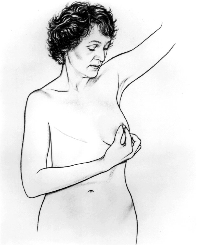 Bse after mastectomy (series of 6) illustration (4)