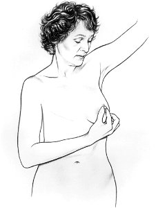 Bse after mastectomy (series of 6) illustration (4)