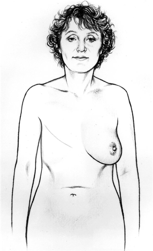 Bse after mastectomy (series of 6) illustration