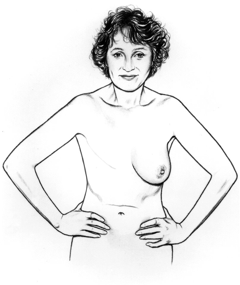 Bse after mastectomy (series of 6) illustration (2)