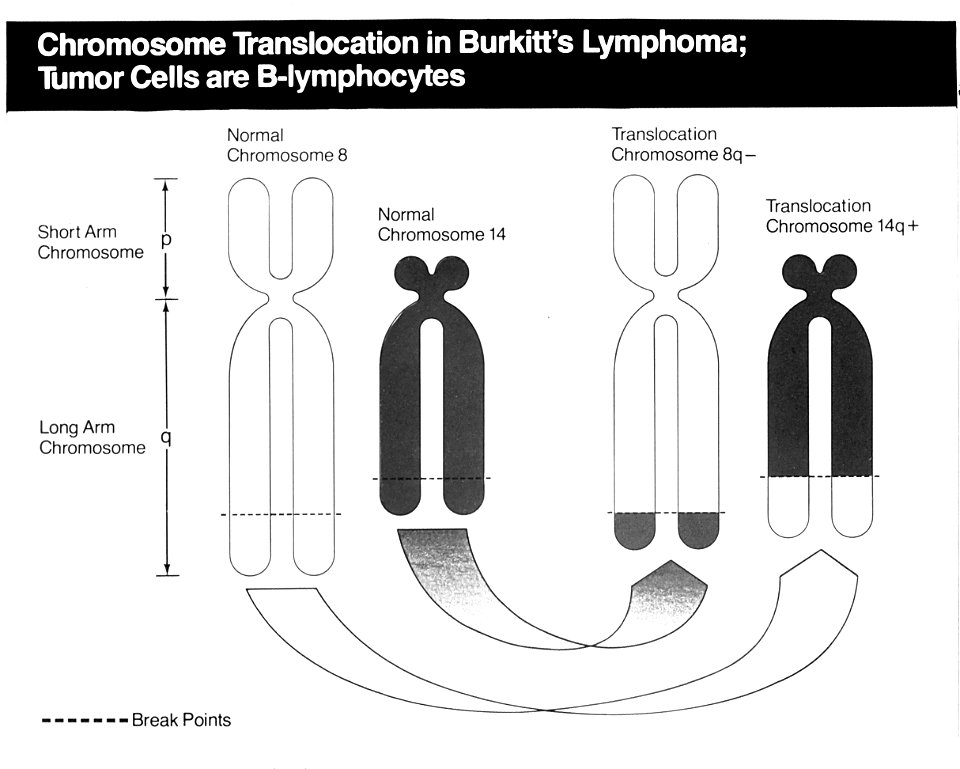 Burkitt's lymphoma illustration