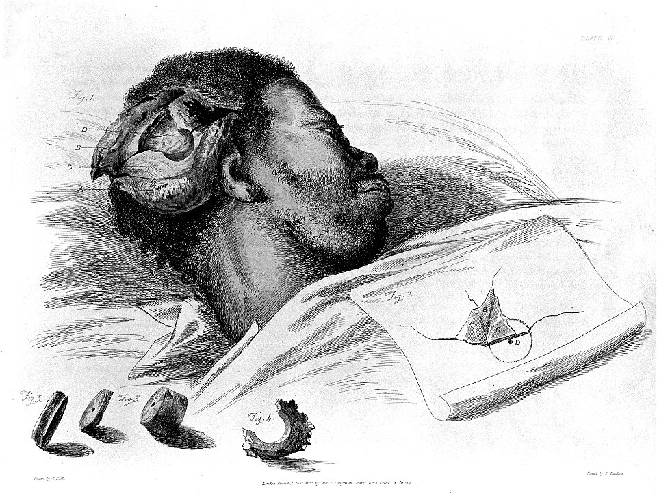 C. Bell, Illustrations of the great operations of surgery... Wellcome L0026635