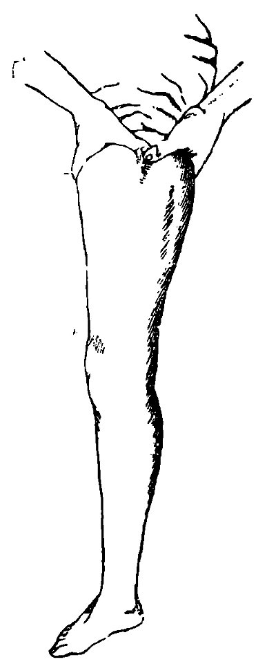 Grierson 75a Compresión digital de la femoral