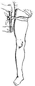 Grierson 77 Compresión de femoral con torniquete