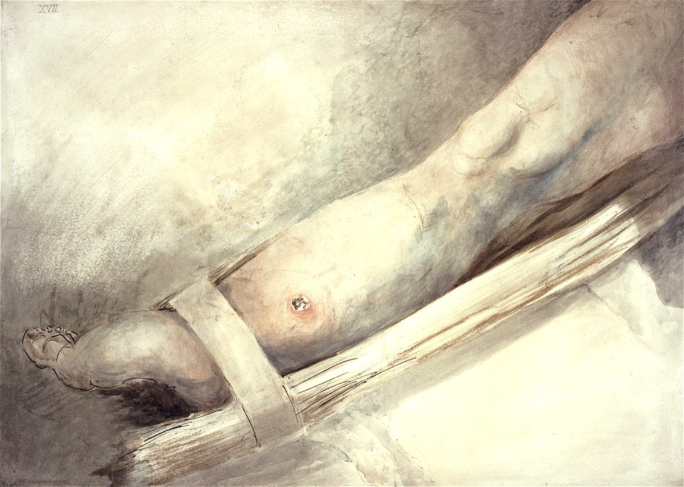 Gunshot fracture of the leg, by Charles Bell Wellcome L0028902