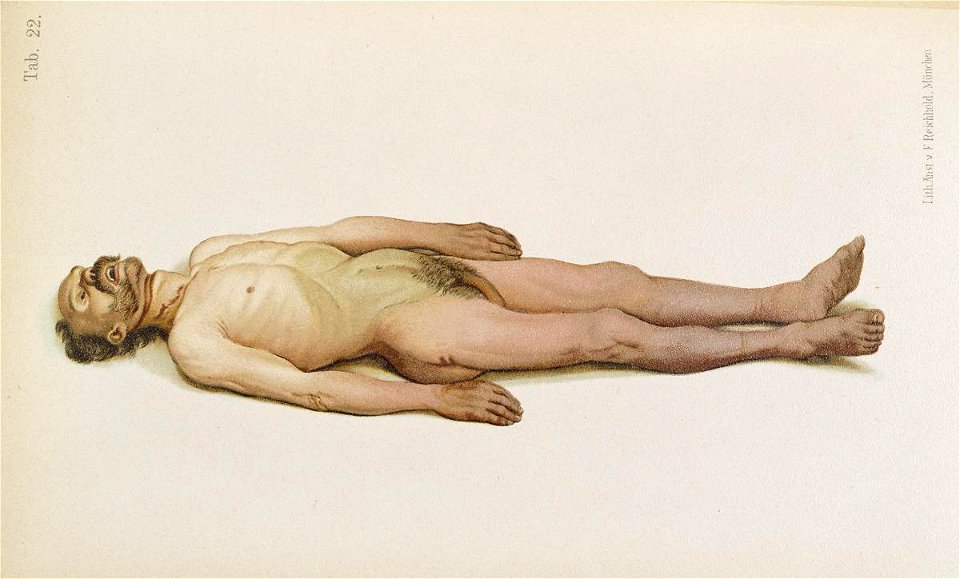 Hofmann Lehrbuch suidide hanging