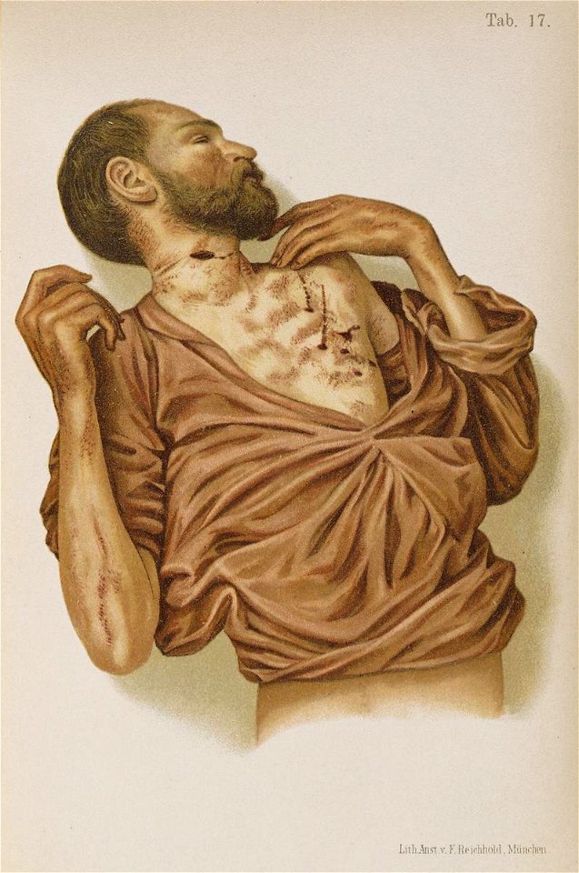 Hofmann Lehrbuch suicide stabbing