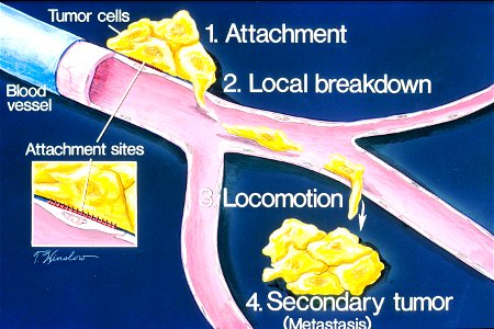 How metastasis occurs illustration