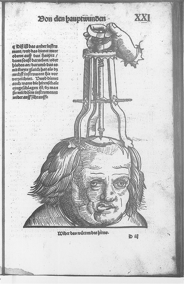 Illustrations in Feldtbuch der Wundartzney(BNF) 004